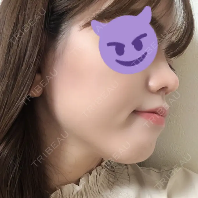 鼻尖形成（切開） みずほクリニック DAY 30 メイン用