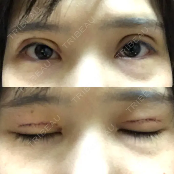 二重切開 ゆめビューティークリニック DAY 5 メイン用