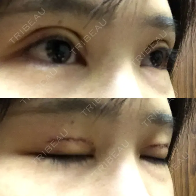 二重切開 ゆめビューティークリニック DAY 5 メイン用