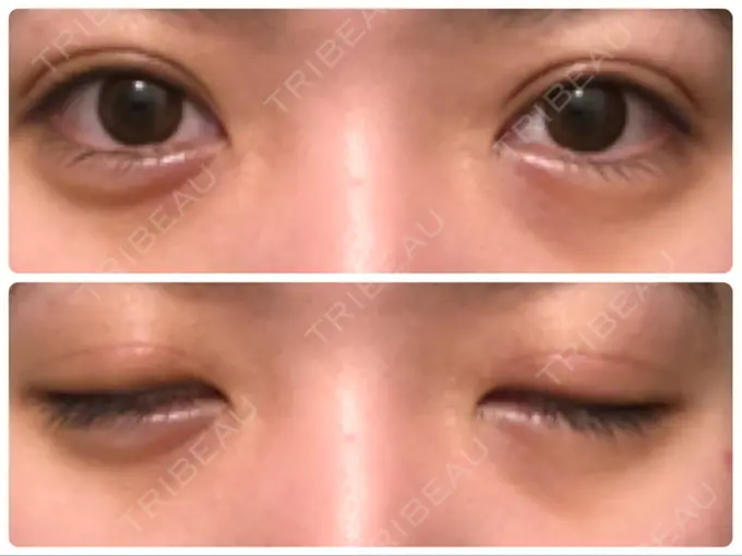 眼瞼下垂（切開） Taide Suenaga Clinic（タイデスエナガクリニック） AFTER メイン用