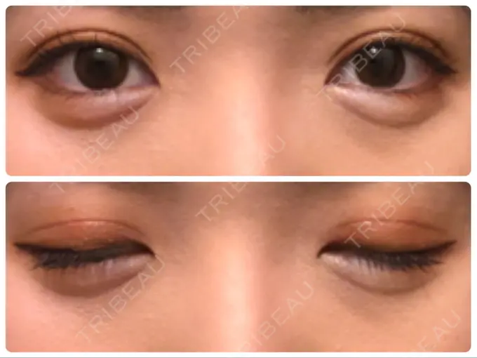 眼瞼下垂（切開） Taide Suenaga Clinic（タイデスエナガクリニック） DAY 101 メイン用