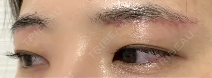 上まぶたの脂肪取り / 眉下切開 城本クリニック 福岡院 DAY 50 メイン用