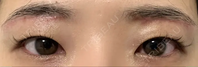 上まぶたの脂肪取り / 眉下切開 城本クリニック 福岡院 AFTER メイン用