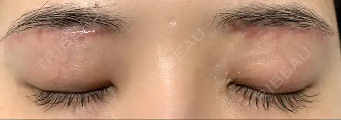 上まぶたの脂肪取り / 眉下切開 城本クリニック 福岡院 DAY 50 メイン用