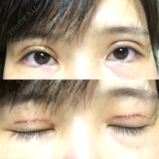 二重切開 ゆめビューティークリニック DAY 7 メイン用