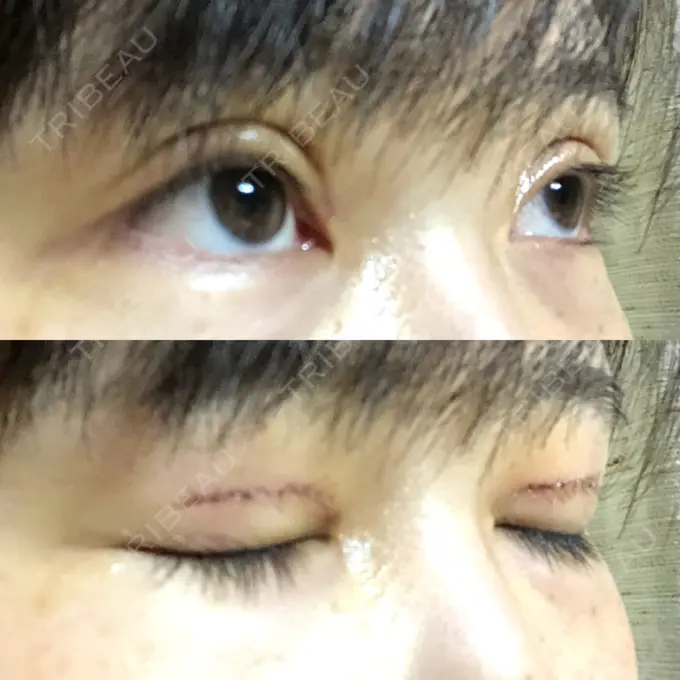 二重切開 ゆめビューティークリニック DAY 7 メイン用