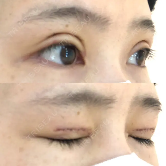 二重切開 ゆめビューティークリニック DAY 7 メイン用