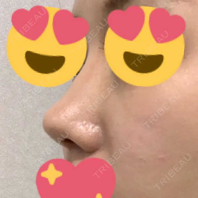 鼻尖形成（切開） / 小鼻縮小（切開） / 軟骨移植 / ワシ鼻修正・ハンプ切除 / 鼻尖縮小 / その他（鼻） B-LINE CLINIC 池袋院 DAY 198 メイン用