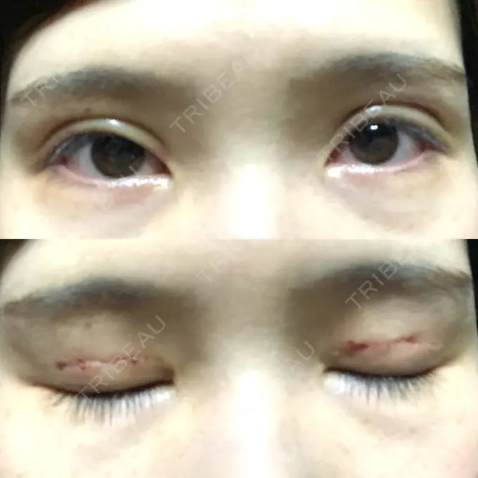 二重切開 ゆめビューティークリニック AFTER メイン用