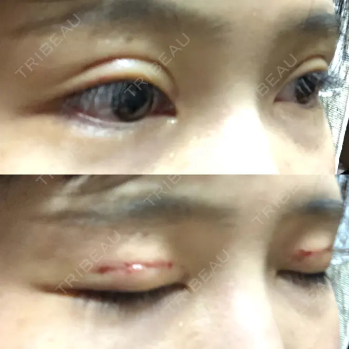 二重切開 ゆめビューティークリニック DAY 7 メイン用