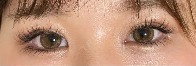 二重埋没 / ヒアルロン酸注入（涙袋） / ヒアルロン酸注入（目の下） 湘南美容クリニック 千葉センシティ院 DAY 22 メイン用