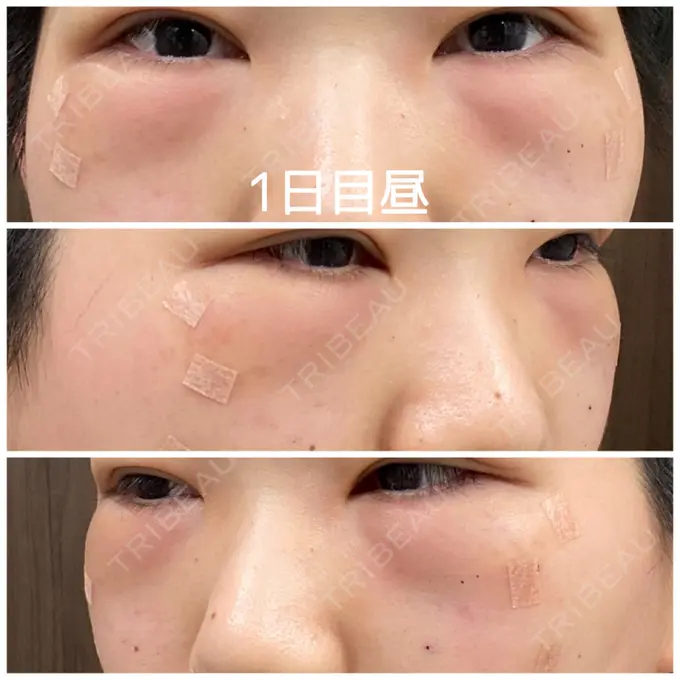 クマ治療 / 下まぶたの脂肪取り / 脂肪注入（輪郭） 湘南美容クリニック 橋本院 DAY 1 メイン用