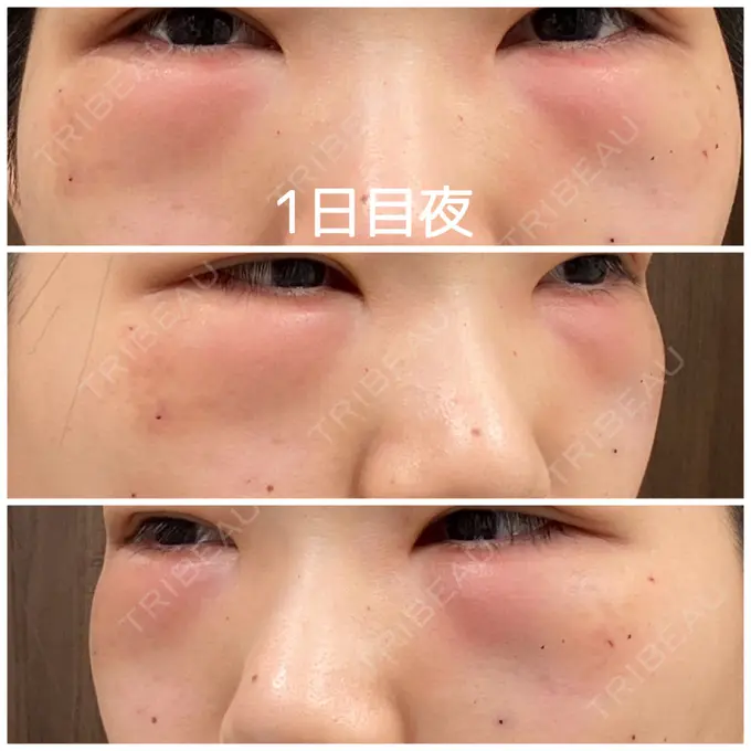 クマ治療 / 下まぶたの脂肪取り / 脂肪注入（輪郭） 湘南美容クリニック 橋本院 DAY 1 メイン用