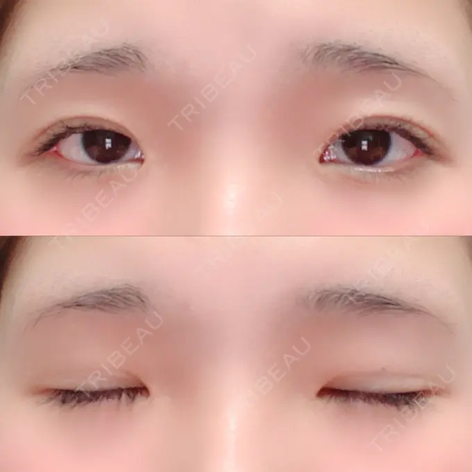 二重埋没 湘南美容クリニック 赤坂見附院 AFTER メイン用