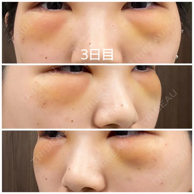 クマ治療 / 下まぶたの脂肪取り / 脂肪注入（輪郭） 湘南美容クリニック 橋本院 DAY 3 メイン用