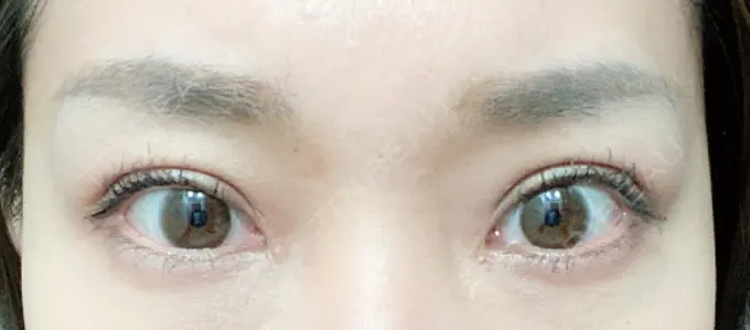 二重切開 / 目頭切開 心斎橋コムロ美容外科クリニック DAY 77 メイン用