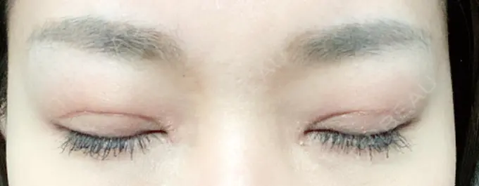 二重切開 / 目頭切開 心斎橋コムロ美容外科クリニック DAY 77 メイン用