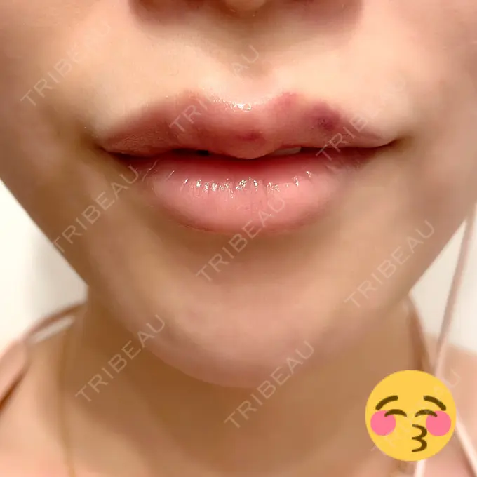 人中短縮 / ヒアルロン酸注入（唇） / ボトックス（口角） アクトリー勝どきウェルネスメディカルクリニック DAY 3 メイン用