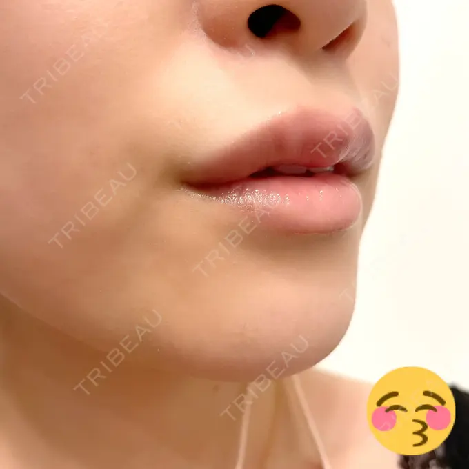 人中短縮 / ヒアルロン酸注入（唇） / ボトックス（口角） アクトリー勝どきウェルネスメディカルクリニック DAY 3 メイン用