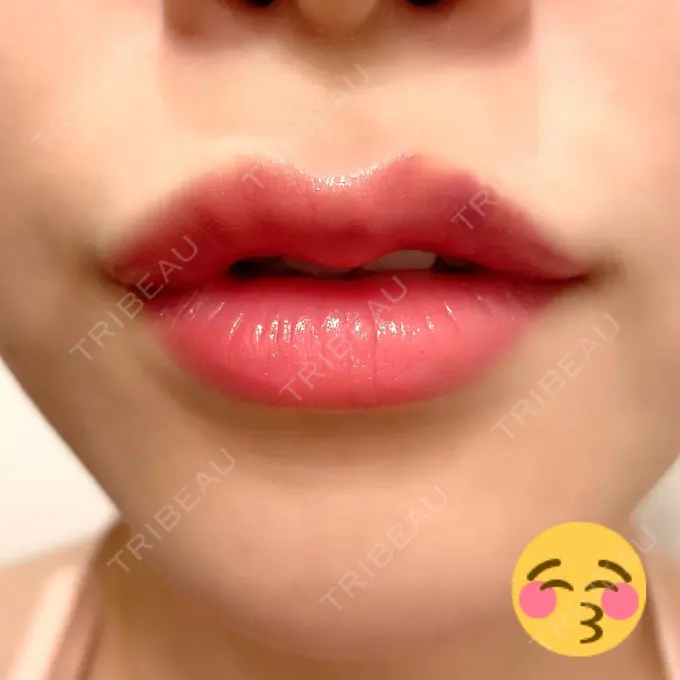 人中短縮 / ヒアルロン酸注入（唇） / ボトックス（口角） アクトリー勝どきウェルネスメディカルクリニック DAY 4 メイン用