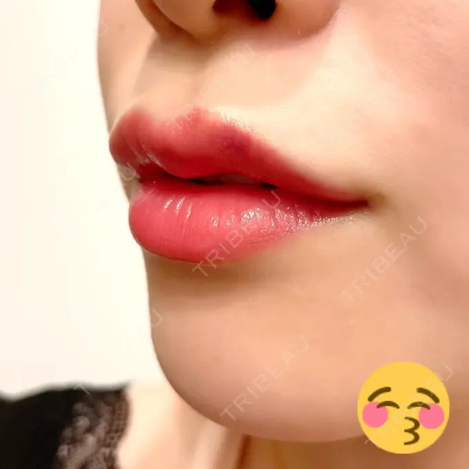 人中短縮 / ヒアルロン酸注入（唇） / ボトックス（口角） アクトリー勝どきウェルネスメディカルクリニック DAY 4 メイン用