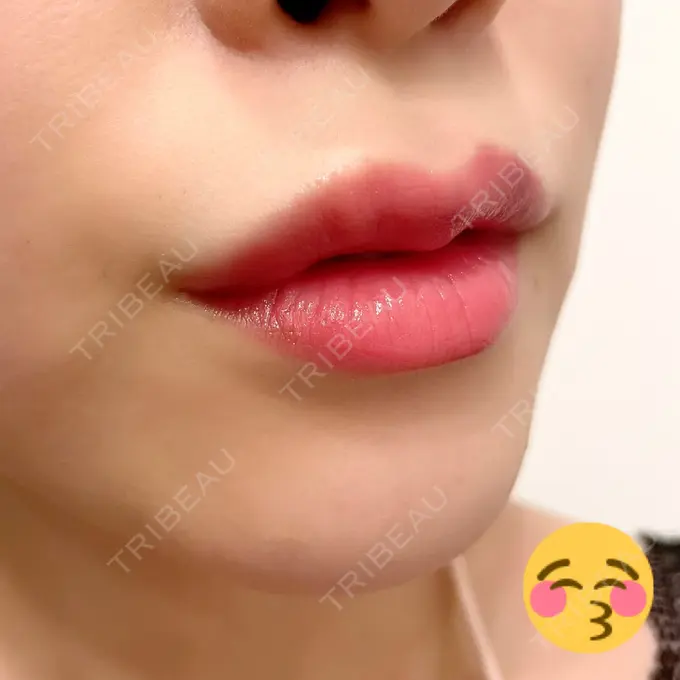 人中短縮 / ヒアルロン酸注入（唇） / ボトックス（口角） アクトリー勝どきウェルネスメディカルクリニック DAY 4 メイン用