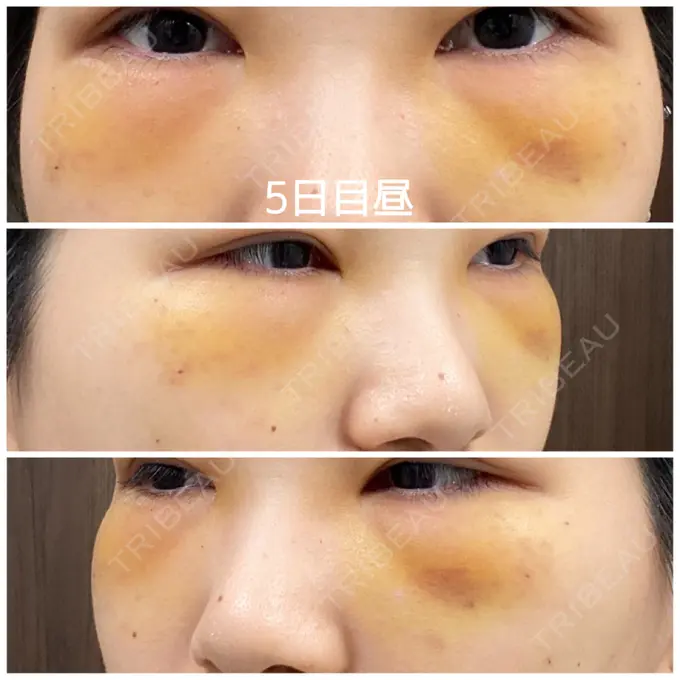 クマ治療 / 下まぶたの脂肪取り / 脂肪注入（輪郭） 湘南美容クリニック 橋本院 DAY 5 メイン用