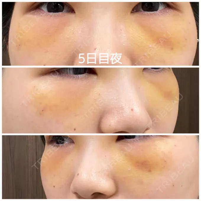 クマ治療 / 下まぶたの脂肪取り / 脂肪注入（輪郭） 湘南美容クリニック 橋本院 DAY 5 メイン用