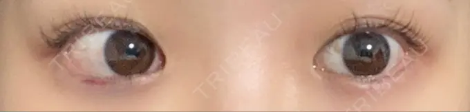 ヒアルロン酸注入（涙袋） 東京皮膚科・形成外科 日本橋院 AFTER メイン用