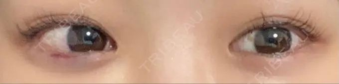 ヒアルロン酸注入（涙袋） 東京皮膚科・形成外科 日本橋院 DAY 0 メイン用