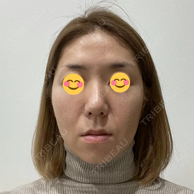 糸リフト / クマ治療 / バッカルファット除去 / 脂肪吸引（顔） / 下まぶたの脂肪取り / メーラーファット除去 湘南美容クリニック 秋葉原院 AFTER メイン用