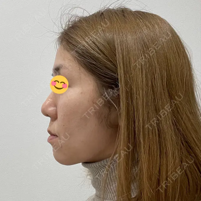 糸リフト / クマ治療 / バッカルファット除去 / 脂肪吸引（顔） / 下まぶたの脂肪取り / メーラーファット除去 湘南美容クリニック 秋葉原院 DAY 92 メイン用