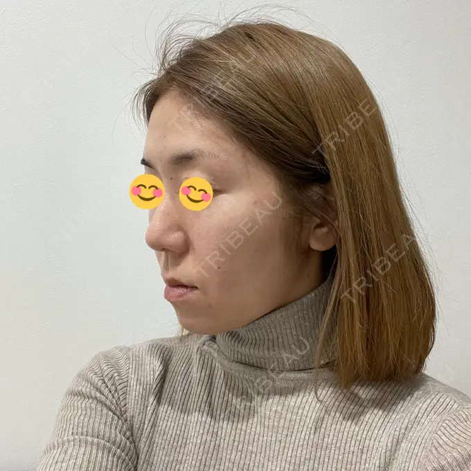 糸リフト / クマ治療 / バッカルファット除去 / 脂肪吸引（顔） / 下まぶたの脂肪取り / メーラーファット除去 湘南美容クリニック 秋葉原院 DAY 92 メイン用