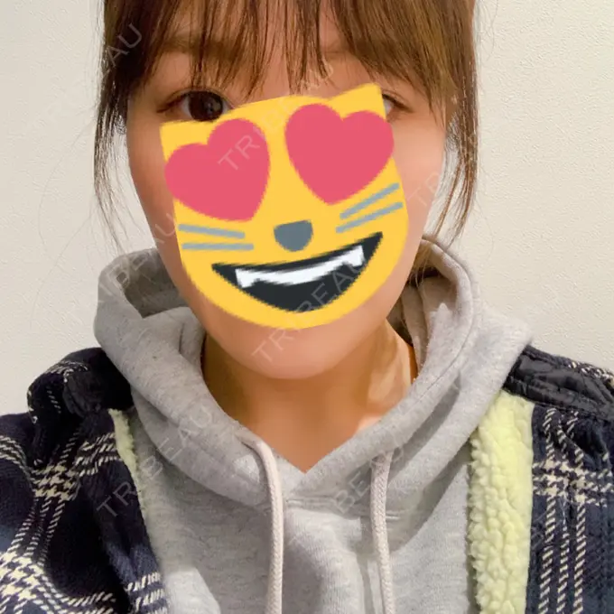 糸リフト / バッカルファット除去 / 脂肪吸引（顔） / メーラーファット除去 / ボトックス（エラ・小顔） 湘南美容クリニック 秋葉原院 AFTER メイン用