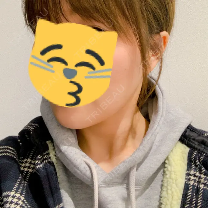 糸リフト / バッカルファット除去 / 脂肪吸引（顔） / メーラーファット除去 / ボトックス（エラ・小顔） 湘南美容クリニック 秋葉原院 DAY 0 メイン用