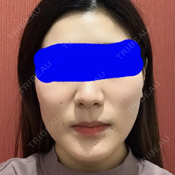 糸リフト / 脂肪吸引（顔） / メーラーファット除去 / ボトックス（エラ・小顔） 湘南美容クリニック 秋葉原院 AFTER メイン用