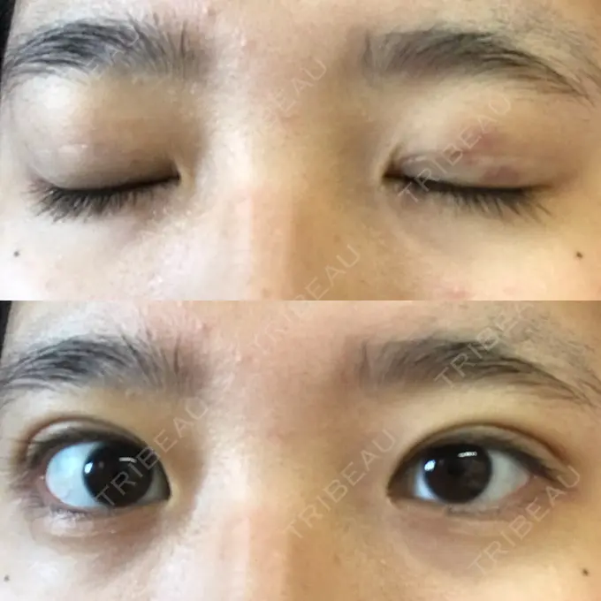 二重埋没 新宿美容外科クリニック 立川院 AFTER メイン用