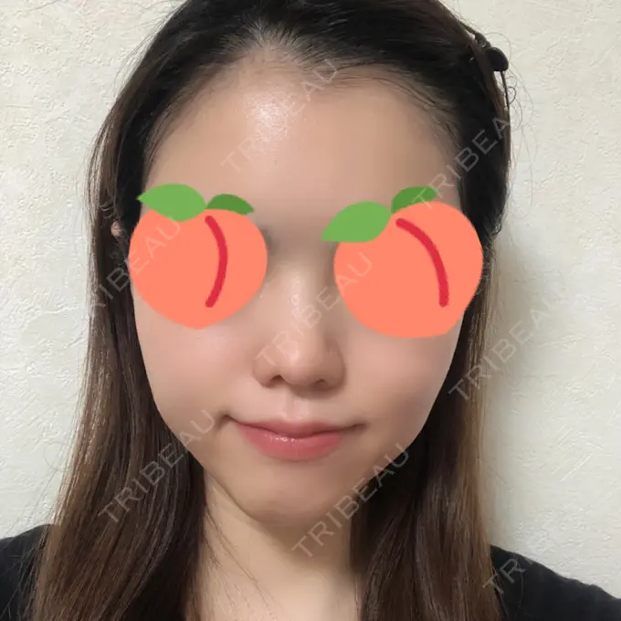 鼻尖形成（切開） みずほクリニック AFTER メイン用