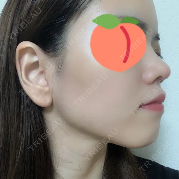 鼻尖形成（切開） みずほクリニック DAY 41 メイン用