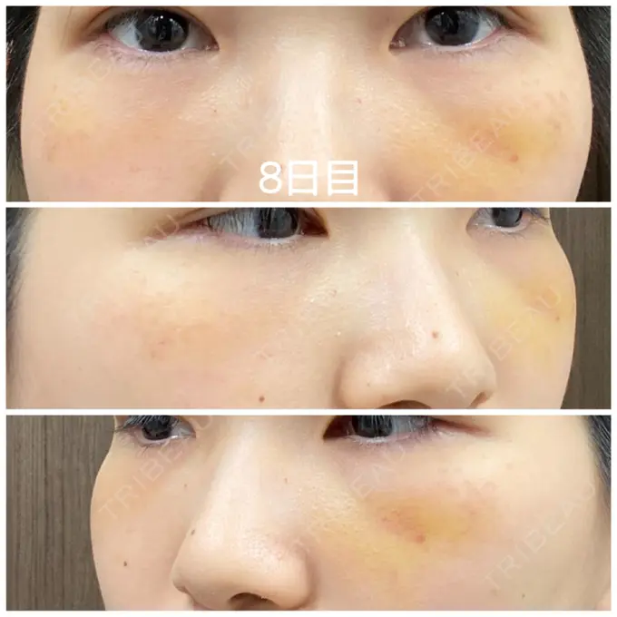 クマ治療 / 下まぶたの脂肪取り / 脂肪注入（輪郭） 湘南美容クリニック 橋本院 DAY 8 メイン用