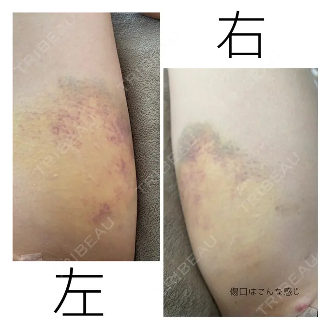 クマ治療 / 下まぶたの脂肪取り / 脂肪注入（輪郭） 湘南美容クリニック 橋本院 DAY 8 メイン用