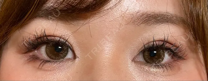 二重埋没 / ヒアルロン酸注入（涙袋） / ヒアルロン酸注入（目の下） 湘南美容クリニック 千葉センシティ院 DAY 30 メイン用