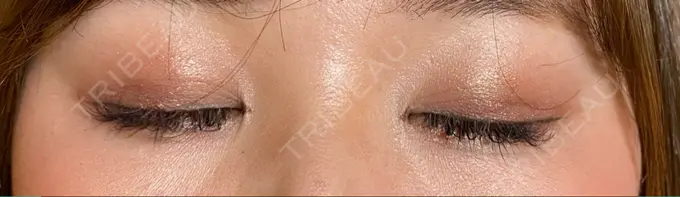 二重埋没 / ヒアルロン酸注入（涙袋） / ヒアルロン酸注入（目の下） 湘南美容クリニック 千葉センシティ院 DAY 30 メイン用