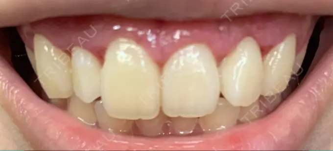 ガミースマイル手術 / その他（口元） / その他（審美歯科/矯正歯科） 南青山矯正歯科 DAY 7 メイン用