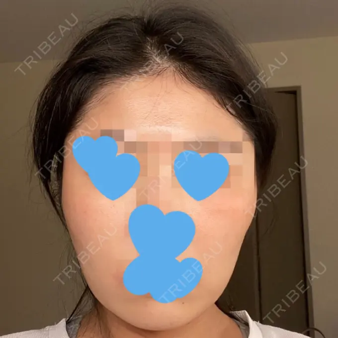 脂肪溶解注射（顔） ビクアスクリニック AFTER メイン用