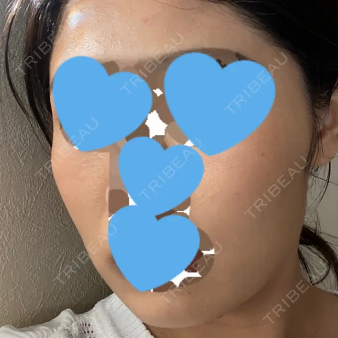 脂肪溶解注射（顔） ビクアスクリニック DAY 77 メイン用