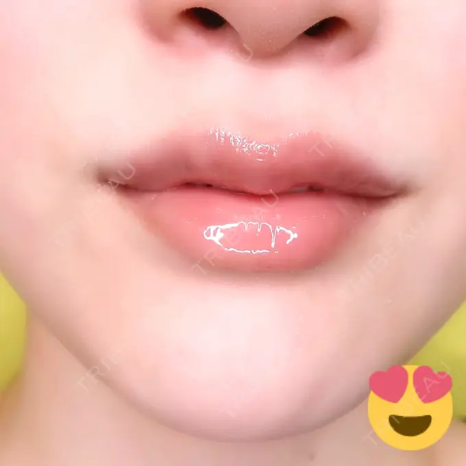 人中短縮 / ヒアルロン酸注入（唇） / ボトックス（口角） アクトリー勝どきウェルネスメディカルクリニック AFTER メイン用