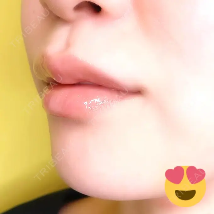 人中短縮 / ヒアルロン酸注入（唇） / ボトックス（口角） アクトリー勝どきウェルネスメディカルクリニック DAY 7 メイン用