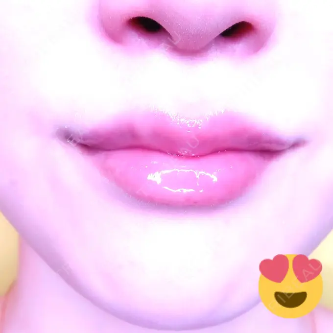 人中短縮 / ヒアルロン酸注入（唇） / ボトックス（口角） アクトリー勝どきウェルネスメディカルクリニック DAY 7 メイン用