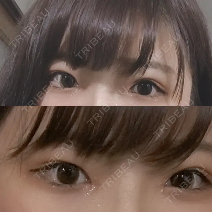 二重埋没 / 目頭切開 湘南美容クリニック 京都院 AFTER メイン用